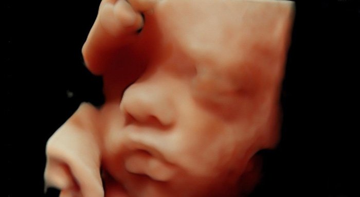 Abortions Declined Slightly in 2022 Following Overturn of Roe v. Wade, CDC Reports